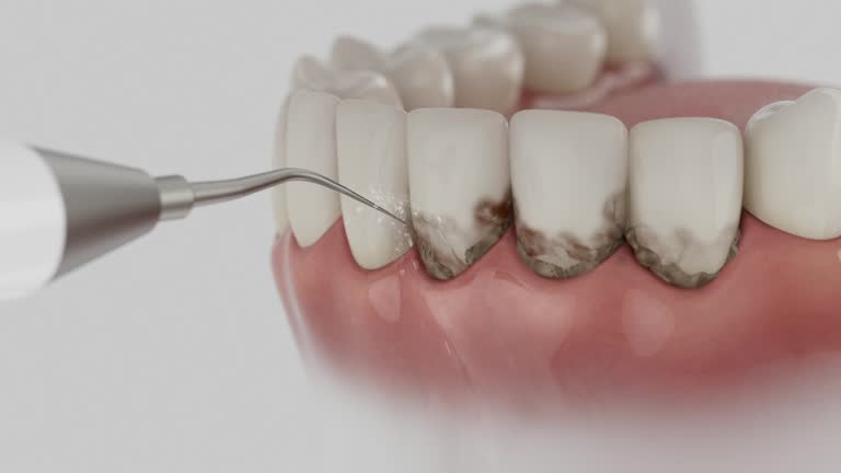 Trusted Wisdom Tooth Removal service in Kalida, OH - Dentist Open Now